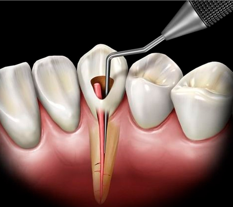 Tratamiento de Endodoncia en Playa del Carmen