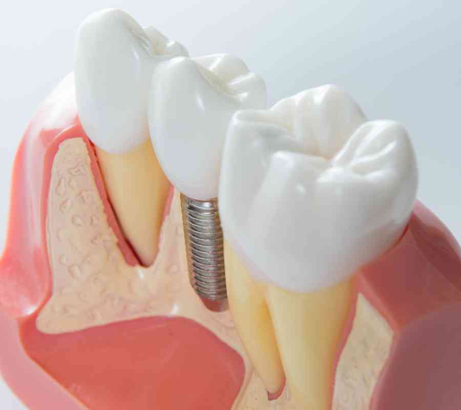 Dental implants