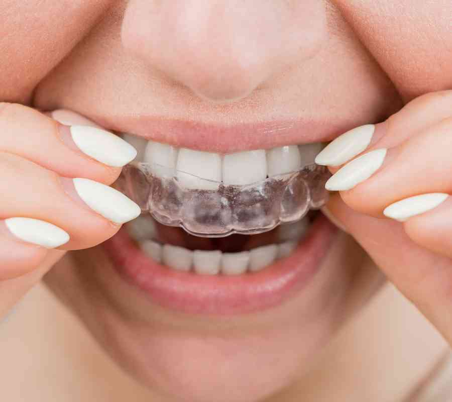 Invisalign treatment
