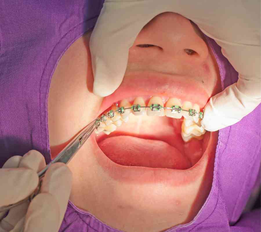 Tratamiento de Ortodoncia en Playa del Carmen